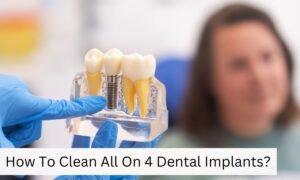 How To Clean All On 4 Dental Implants?