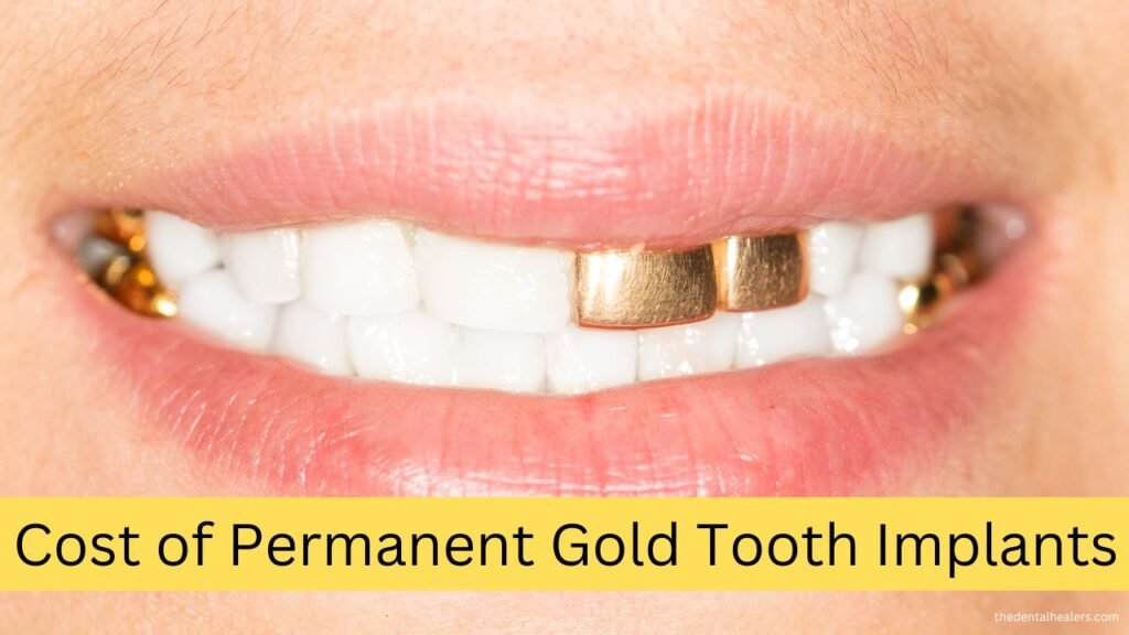 Cost of Permanent Gold Tooth Implants