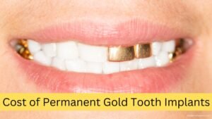 Permanent Gold Teeth: A Guide to Costs of Implants, Grillz, and Caps