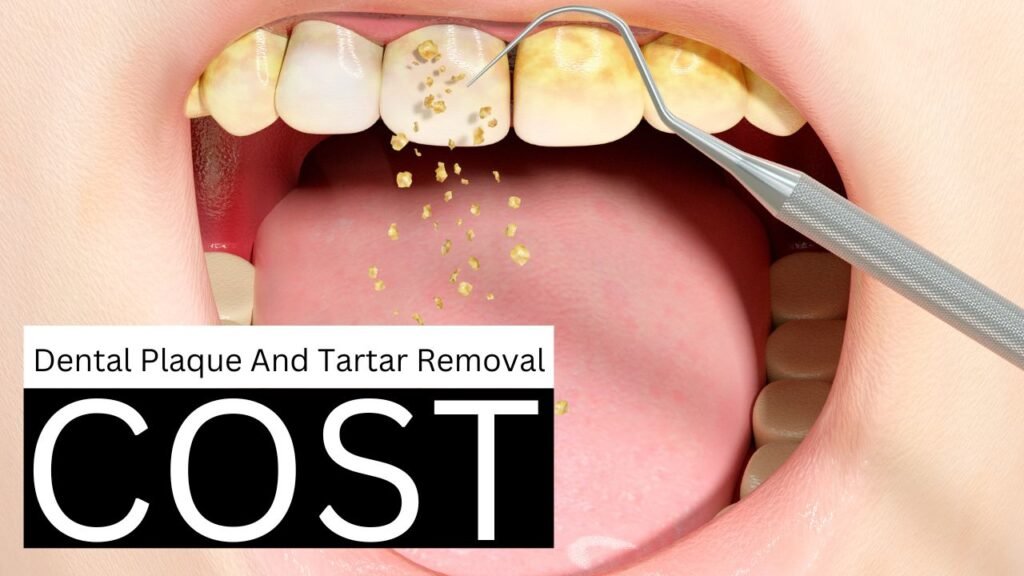 How Much Does Dental Plaque And Tartar Removal Cost