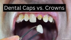 Dental Caps vs Crowns: A Comprehensive Guide to Making the Right Choice