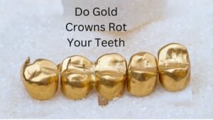 Do Gold Crowns Rot Your Teeth? The Truth Revealed