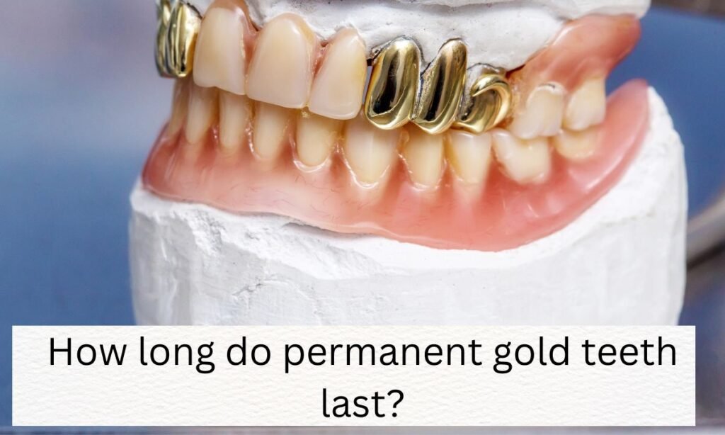 How long do permanent gold teeth last