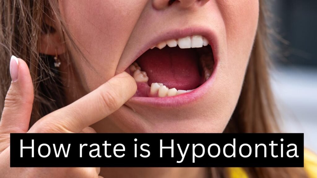 How rate is hypodontia How rate is hypodontia