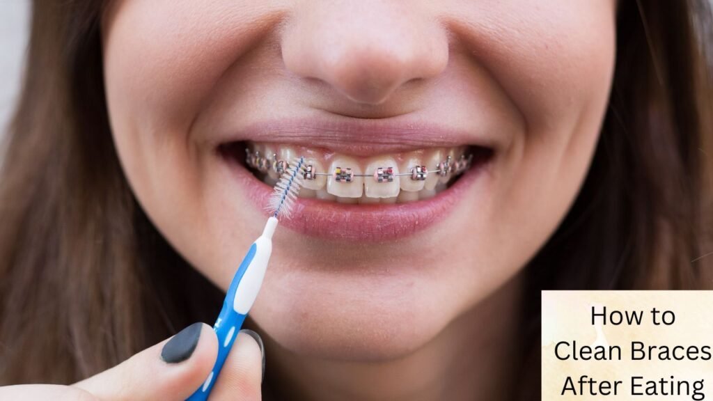 How to Clean Braces After Eating: The Ultimate Guide for a Bright Smile 1 How to Clean Braces After Eating