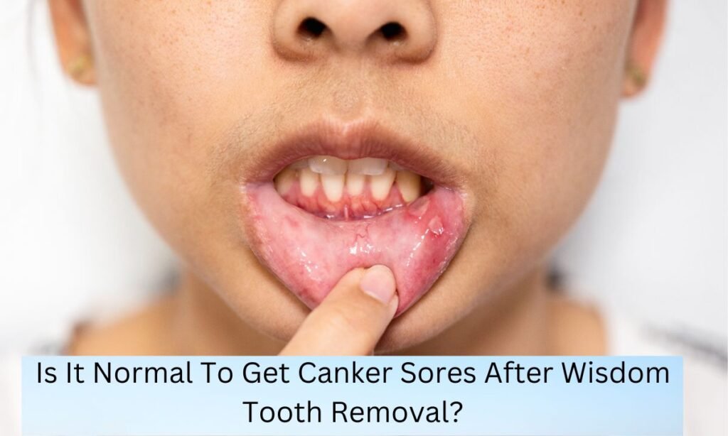 Is It Normal To Get Canker Sores After Wisdom Tooth Removal Is It Normal To Get Canker Sores After Wisdom Tooth Removal