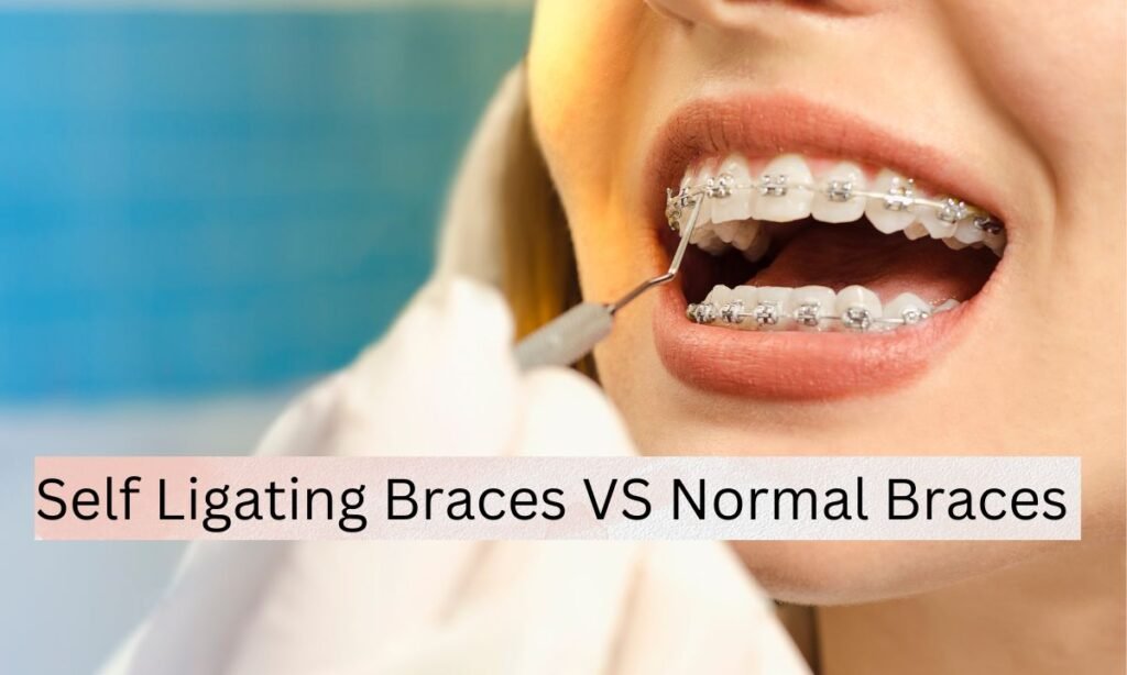 Self Ligating Braces VS Normal Braces Self Ligating Braces VS Normal Braces