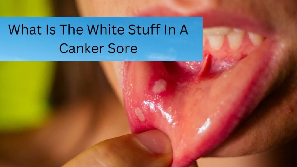 What Is The White Stuff In A Canker Sore What Is The White Stuff In A Canker Sore