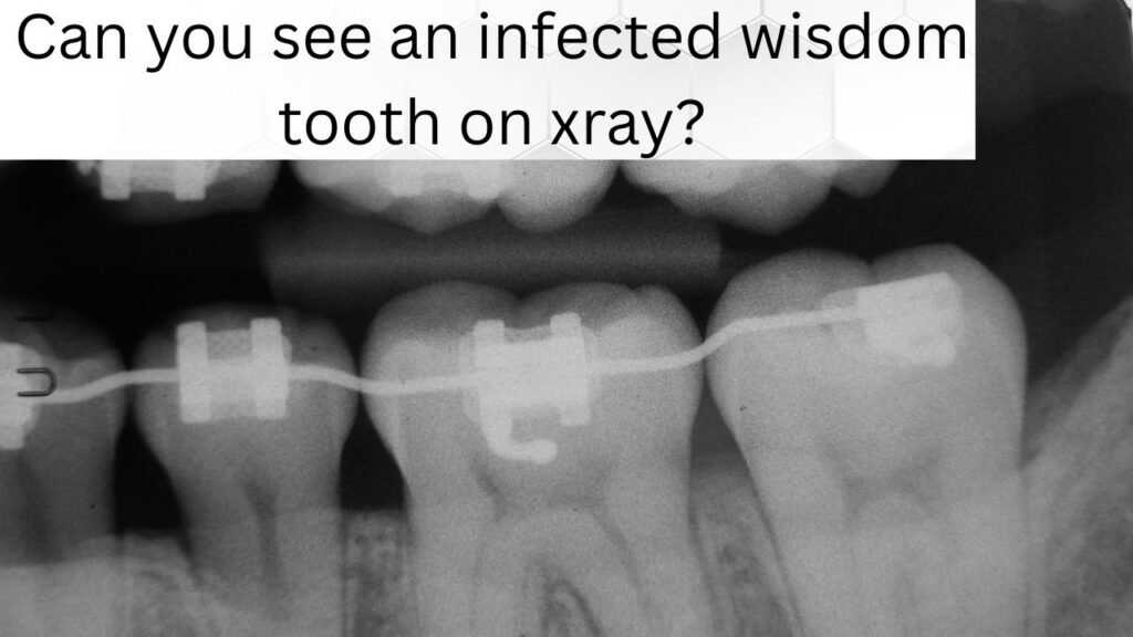Can you see an infected wisdom tooth on xray Can you see an infected wisdom tooth on xray?