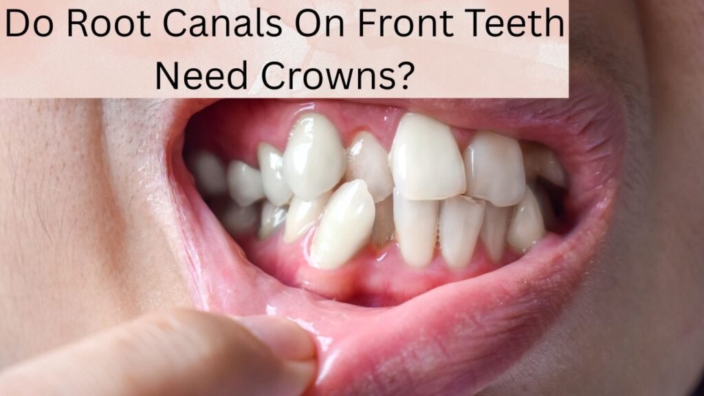 Do Root Canals On Front Teeth Need Crowns Do Root Canals On Front Teeth Need Crowns?