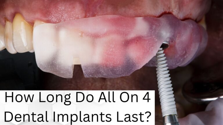 How Long Do All On 4 Dental Implants Last?