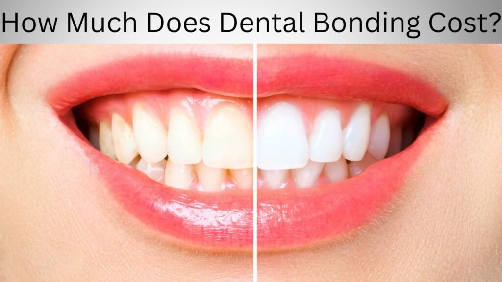 How Much Does Dental Bonding Cost How Much Does Dental Bonding Cost?