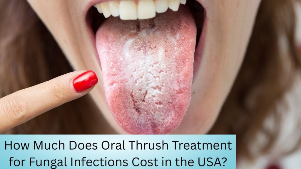 How Much Does Oral Thrush Treatment for Fungal Infections Cost in the USA How Much Does Oral Thrush Treatment for Fungal Infections Cost in the USA?
