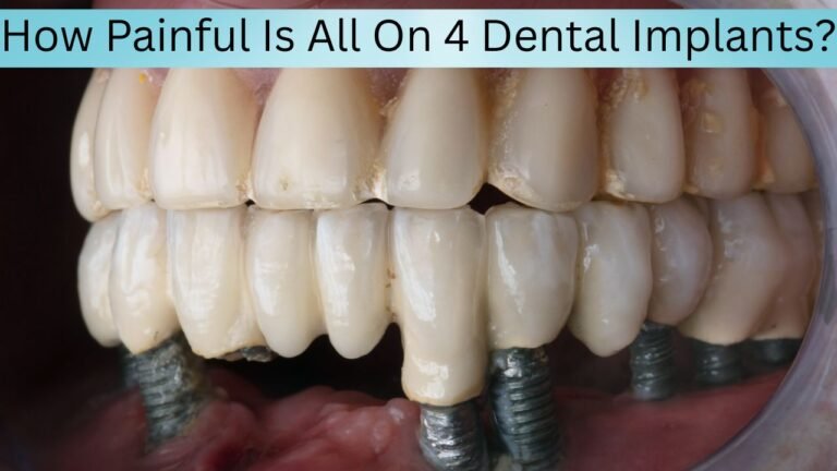 How Painful Is All On 4 Dental Implants?