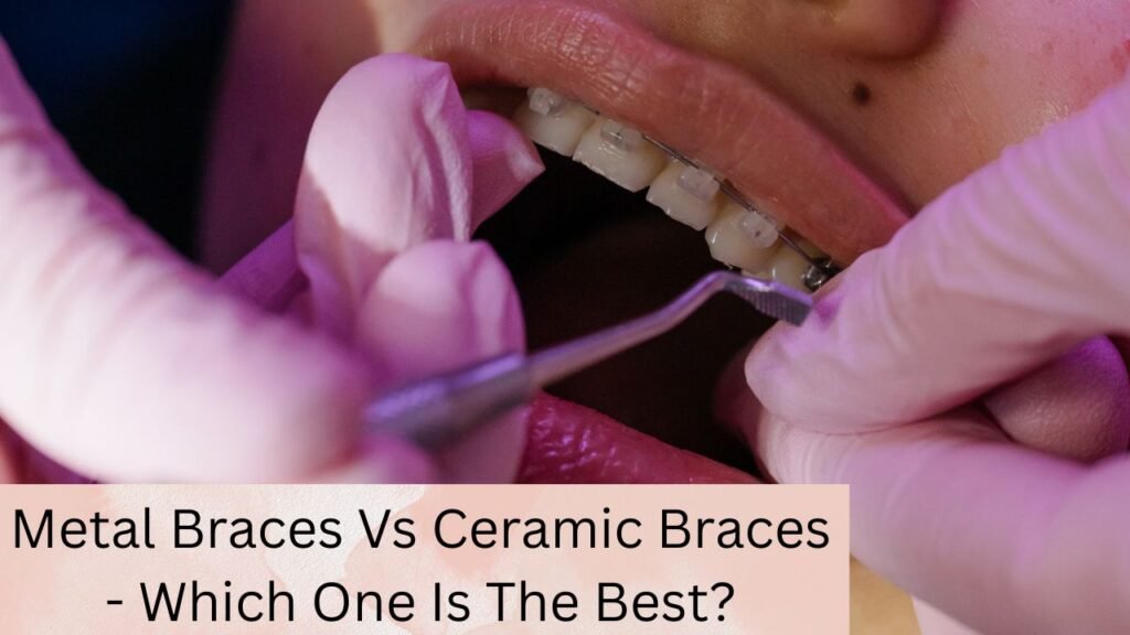 Metal Braces Vs Ceramic Braces - Which One Is The Best Metal Braces Vs Ceramic Braces - Which One Is The Best?