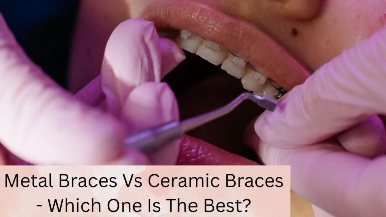 Metal Braces Vs Ceramic Braces – Which One Is The Best?