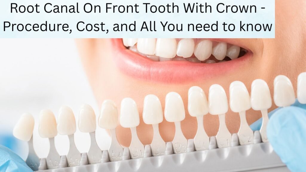Root Canal On Front Tooth With Crown - Procedure, Cost, and All You need to know (1) Root Canal On Front Tooth With Crown - Procedure, Cost, and All You need to know