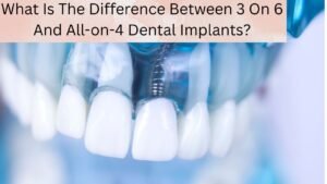 What Is The Difference Between 3 On 6 And All-on-4 Dental Implants?