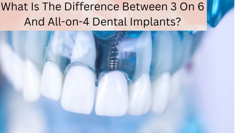 What Is The Difference Between 3 On 6 And All-on-4 Dental Implants?