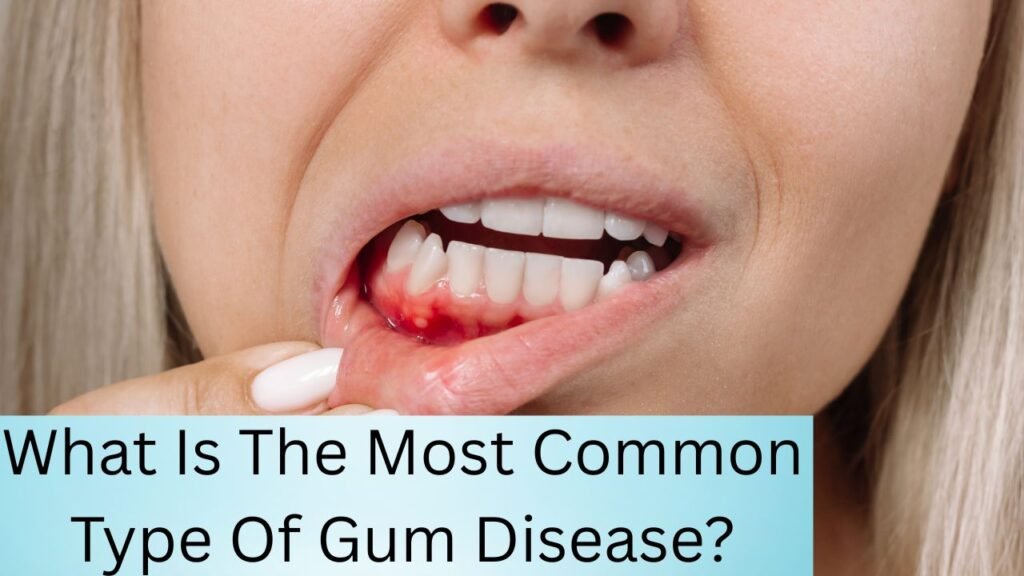 What Is The Most Common Type Of Gum Disease What Is The Most Common Type Of Gum Disease?