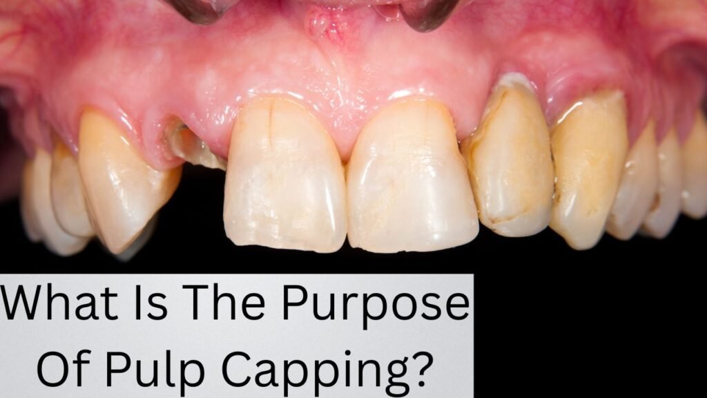 What Is The Purpose Of Pulp Capping What Is The Purpose Of Pulp Capping?