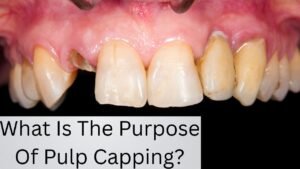 What Is The Purpose Of Pulp Capping?