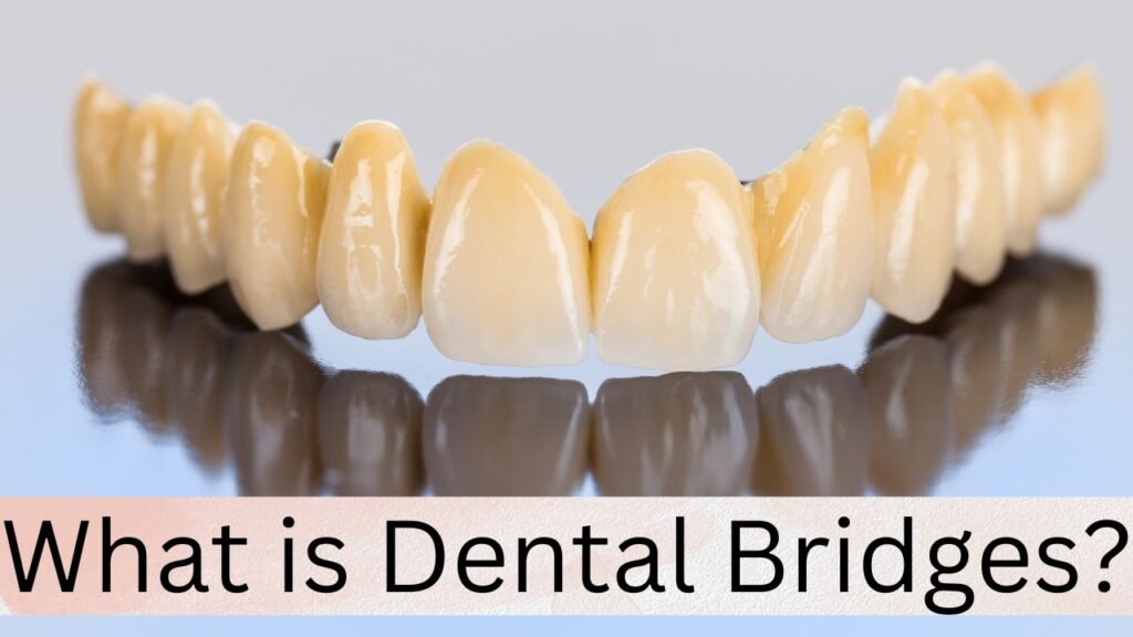 What is Dental Bridges What is Dental Bridges?