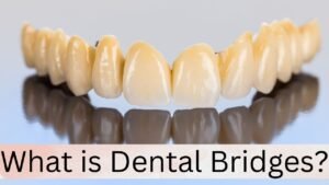 What is Dental Bridges?