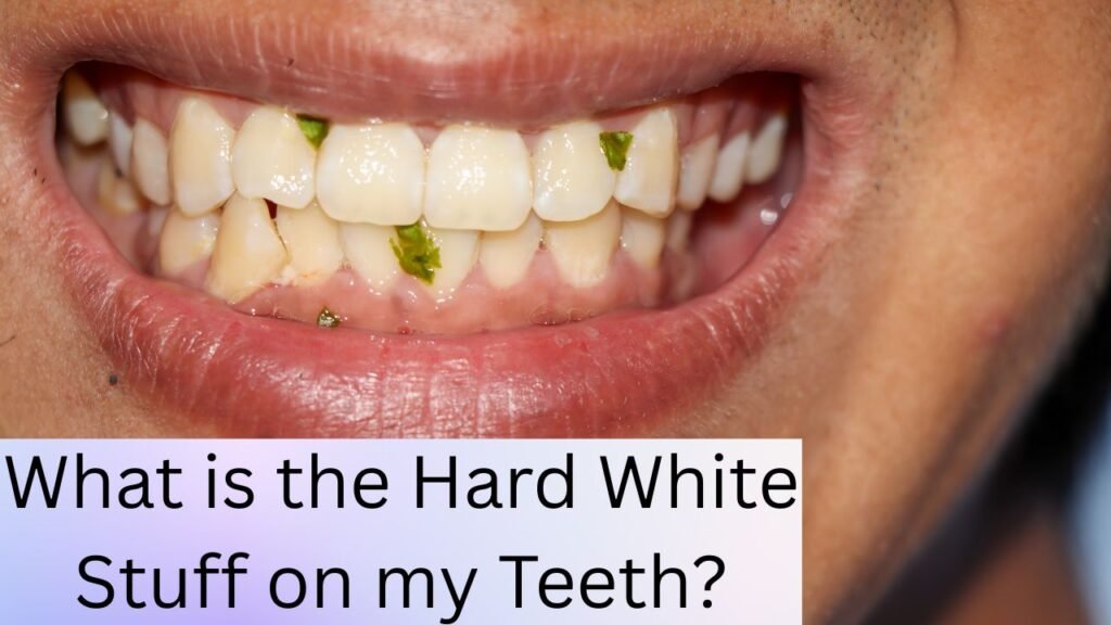 What is the Hard White Stuff on my Teeth What is the Hard White Stuff on my Teeth?