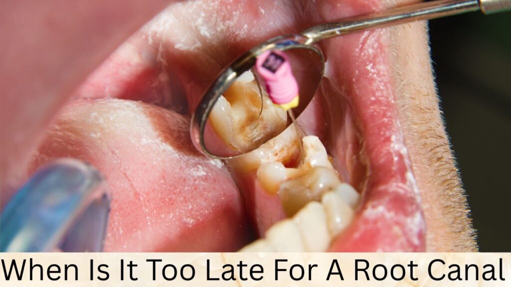 When Is It Too Late For A Root Canal When Is It Too Late For A Root Canal